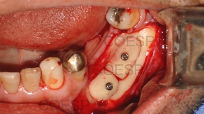 Imersão em Endodontia do Acesso à obturação