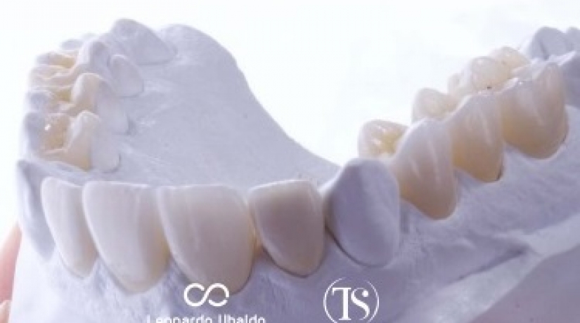 Finalização Estética pós Ortodontia com Resina Composta 
