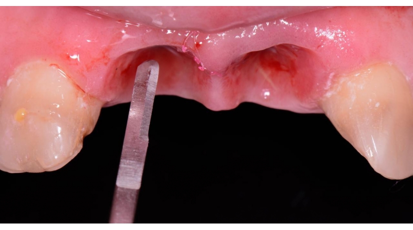 Implante com Cap. em Cirurgias Plásticas Periimplantares Odont. Digital e Prótese Sobre Implante