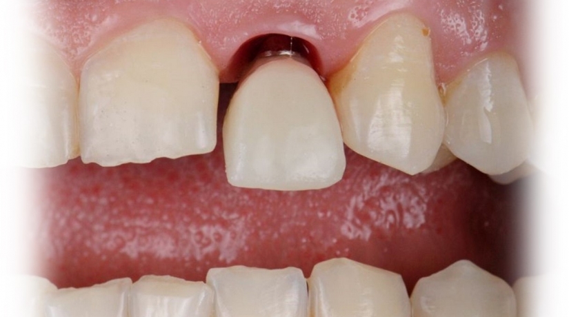 Implantodontia com Aperfeiçoamento em Prótese Dentária e sobre Implante